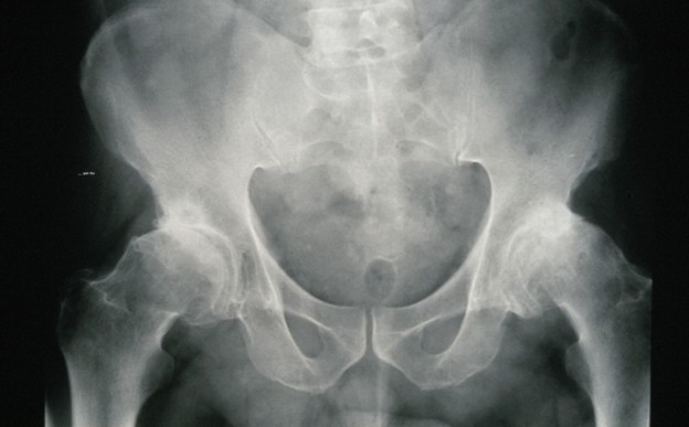 Osteoarthritis Credit: Wellcome Photo Library. Wellcome Images images@wellcome.ac.uk http://wellcomeimages.org Osteoarthritis